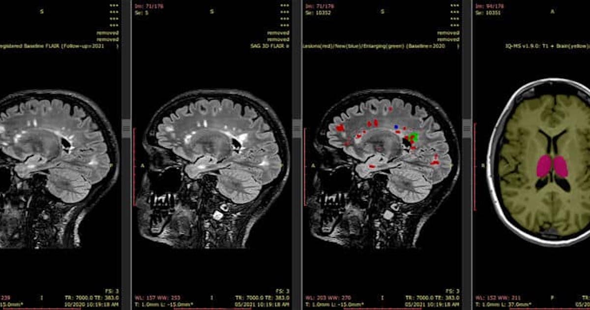 Sydney Neuroimaging Analysis Centre bags grant for dementia, multiple sclerosis analysis AI